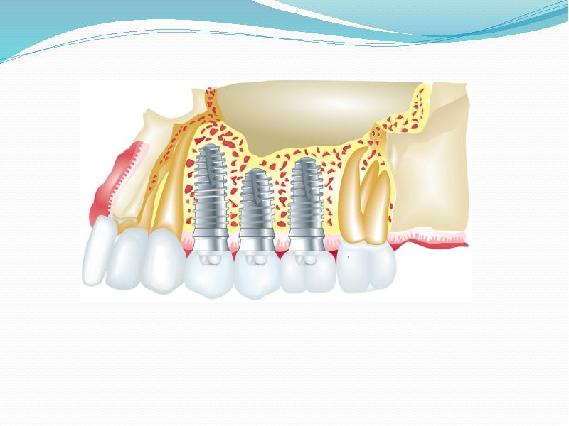 Дентальная имплантация презентация