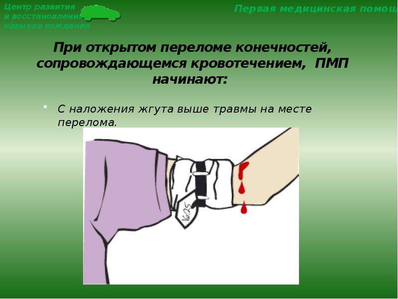 Кровотечение при открытом переломе конечности. Наложение жгута при переломе. Жгут при открытом переломе. При открытом переломе конечностей. Первая помощь при открытых переломах с артериальным кровотечением.