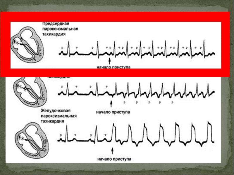 Пароксизмальная тахикардия презентация