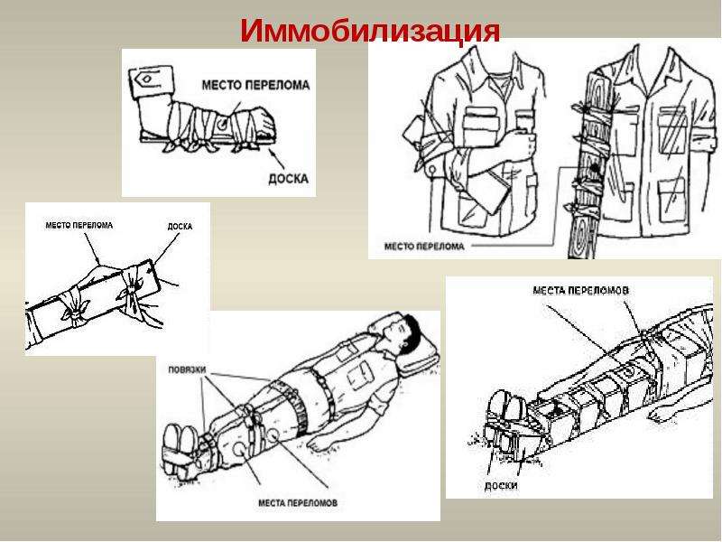 Первая помощь при ушибах переломах костей и вывихах суставов 8 класс презентация по биологии