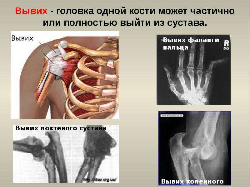 Презентация по теме первая помощь при ушибах переломах костей и вывихах суставов 8 класс