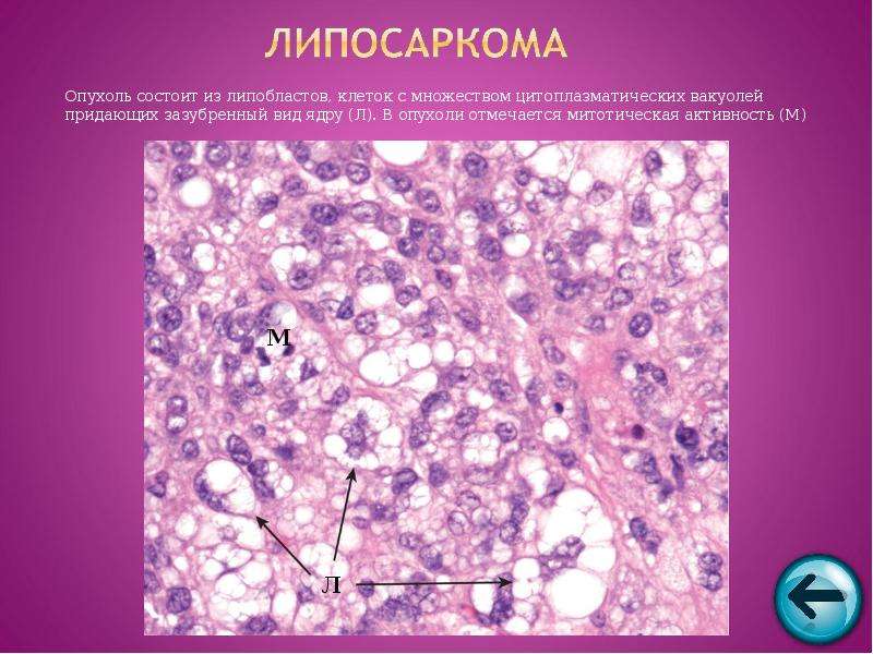 Фибросаркома микропрепарат рисунок