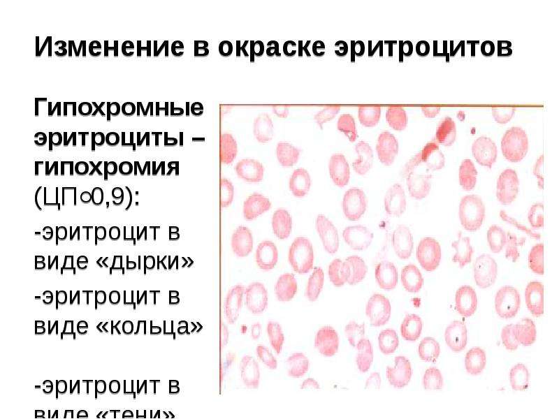 Гипохромия железодефицитная анемия