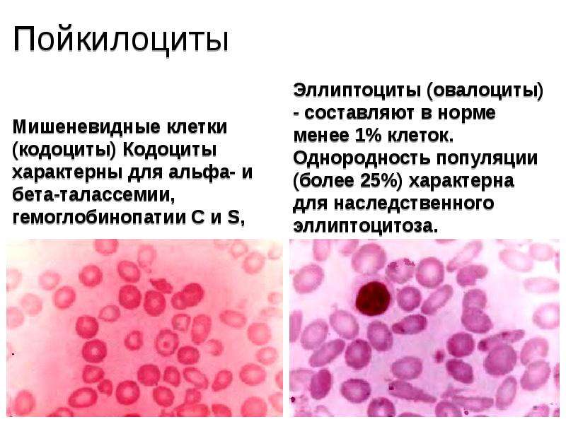 Эритромиелоз картина крови