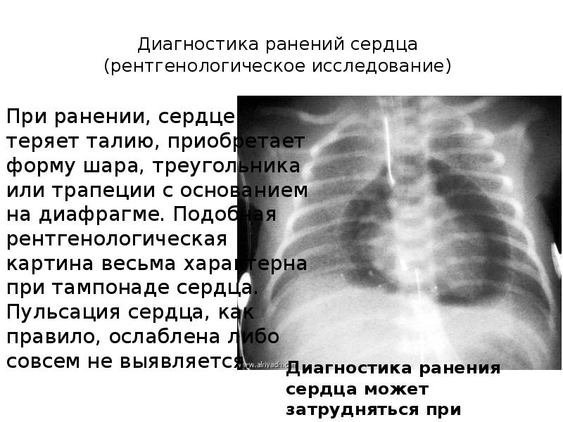 Диагностика ранений сердца (рентгенологическое исследование) При ранении, сердце теряет талию, приоб