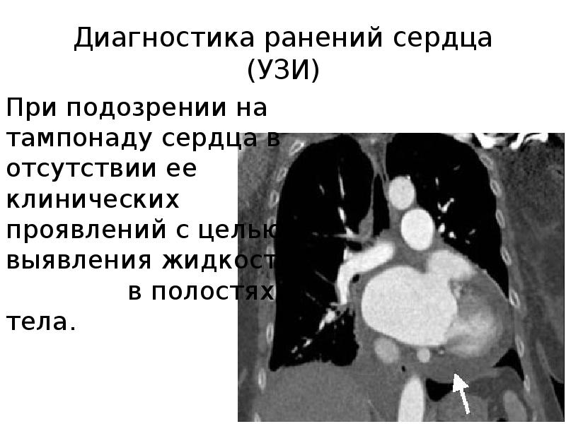 Диагностика ранений сердца (УЗИ) При подозрении на тампонаду сердца в отсутствии ее клинических проя
