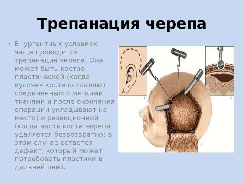 Трепанация черепа. Костно-пластическая Трепанация черепа этапы операции. Костно пластическая Трепанация показания. Однолоскутная Трепанация черепа. Костнопластическая Трепанация черепа показания.