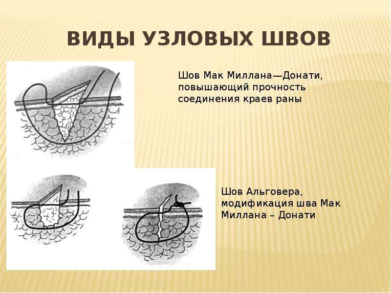 Виды хирургических швов презентация