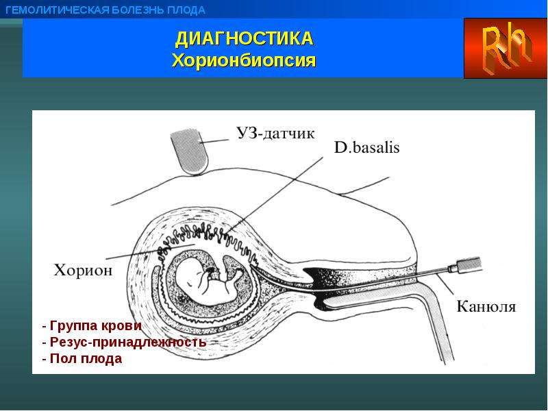 Гемолитическая болезнь плода презентация