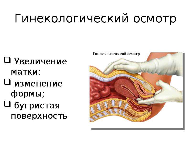 Увеличение матки. Влагалищное обследование.