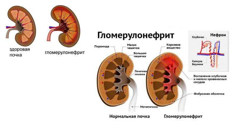 Гломерулонефрит и пиелонефрит презентация