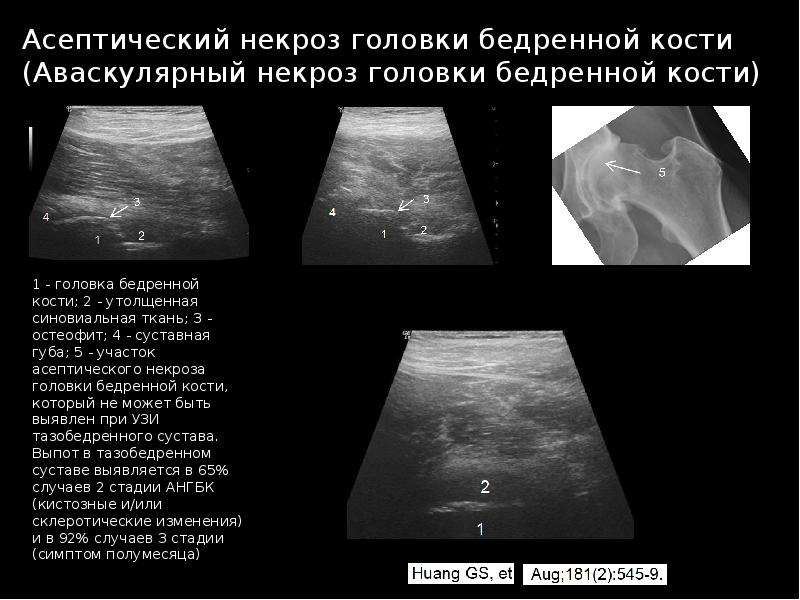 Что покажет узи тазобедренного сустава. Исследование тазобедренного сустава по УЗИ. Шеечно-капсулярное пространство на УЗИ. Шеечно-капсулярное пространство тазобедренного сустава.