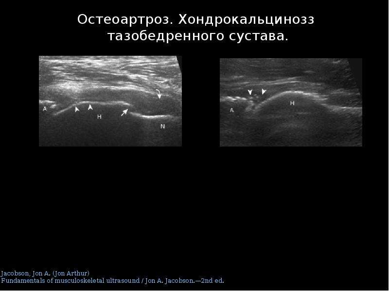 Что покажет узи тазобедренного сустава. Шеечно-капсулярное пространство тазобедренного сустава УЗИ. УЗИ тазобедренного сустава протокол. УЗИ тазобедренного сустава протокол УЗИ. УЗИ тазобедренного сустава заключение.