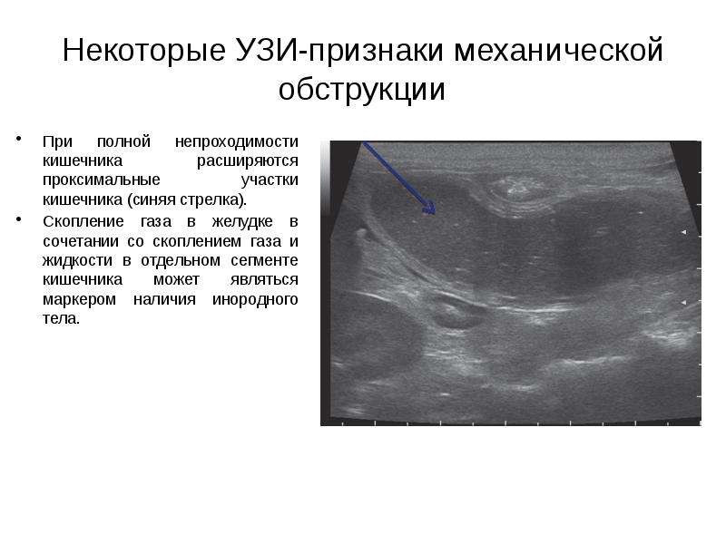 Что показывает узи. Толстокишечная непроходимость на УЗИ.