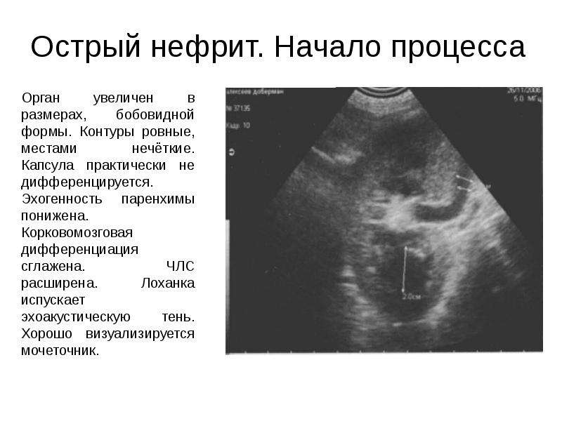 Гломерулонефрит узи картина