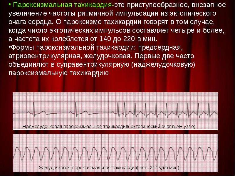 Тахикардия это. Пароксизмальная тахикардия ритм синусовый. Синусовая наджелудочковая тахикардия пароксизмальная. Пароксизмальная экстрасистолия ЭКГ. Пароксизмальная брадикардия ЭКГ.