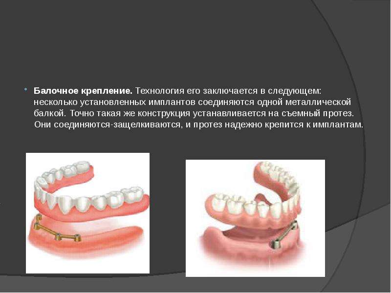 Методы фиксации и стабилизации съемных протезов при полном отсутствии зубов презентация