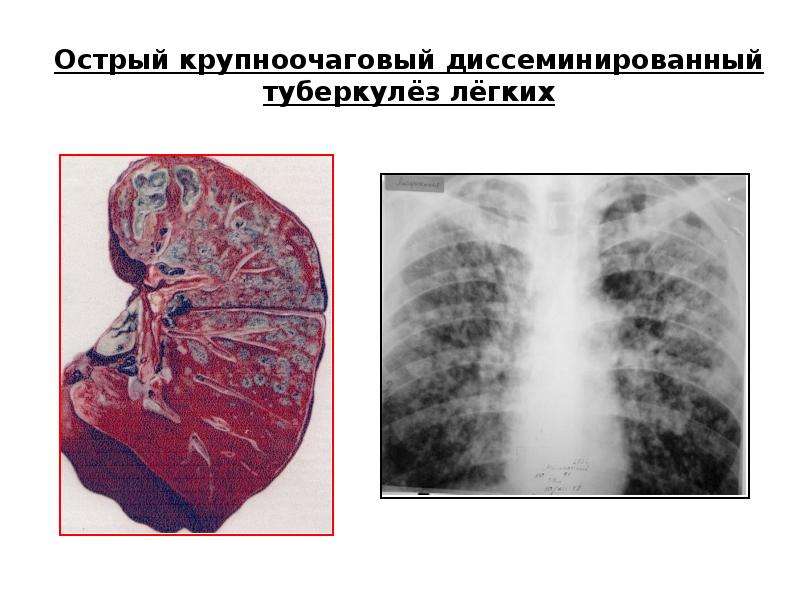 Формы туберкулеза картинки