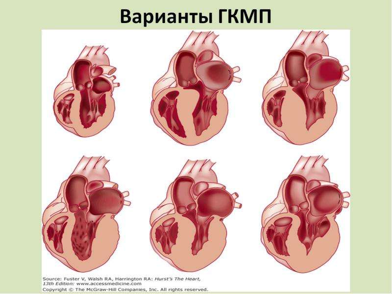 Утолщение сердечной стенки