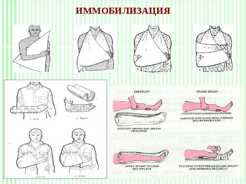 Типы иммобилизации. Иммобилизация. Средства транспортной иммобилизации. Современная транспортная иммобилизация. Иммобилизация виды транспортной иммобилизации.