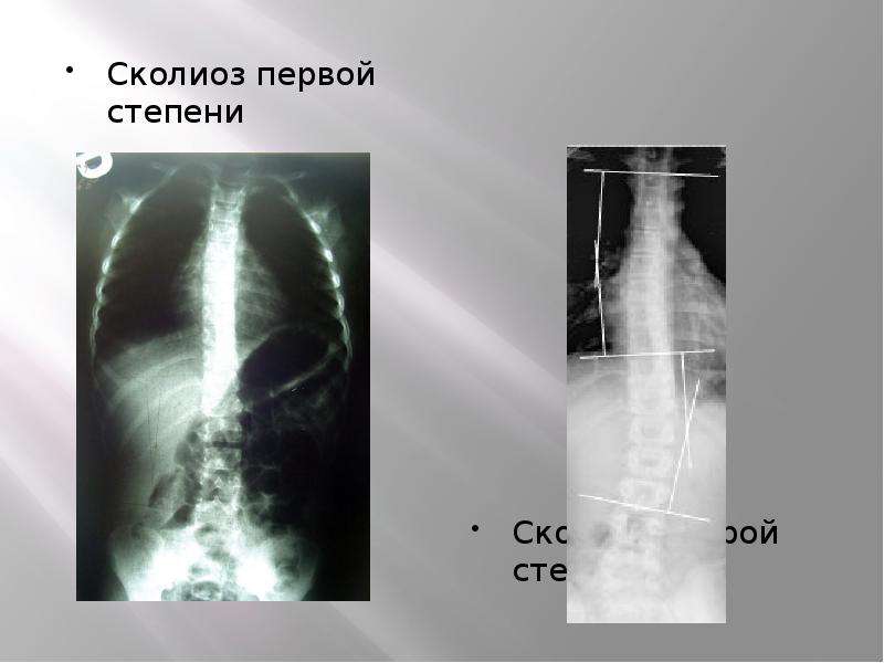 Степени сколиоза по градусам фото