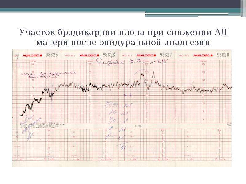 Фото ктг при родах