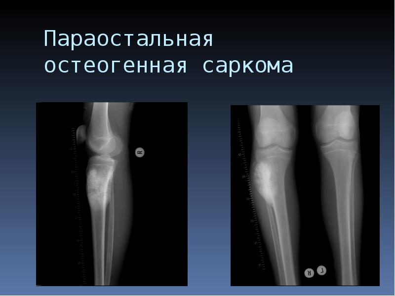 Саркомы мягких тканей презентация