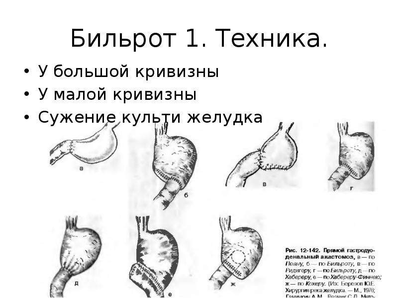 Операции по бильрот 1 и 2 схема