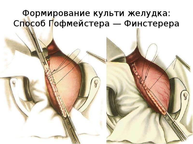 Результаты после резекции желудка фото