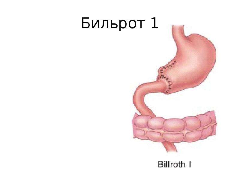 Операции по бильрот 1 и 2 схема