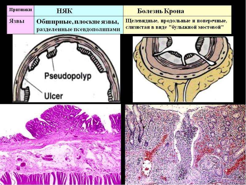 Гистологическая картина болезни крона