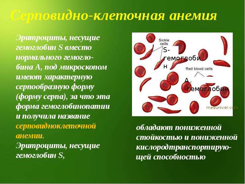 Почему пониженные эритроциты. Серповидноклеточная анемия эритроциты форма. Серповидная анемия эритроциты. Гемоглобин s при серповидноклеточной анемии. Серповидно клеточная анемия вид человека.