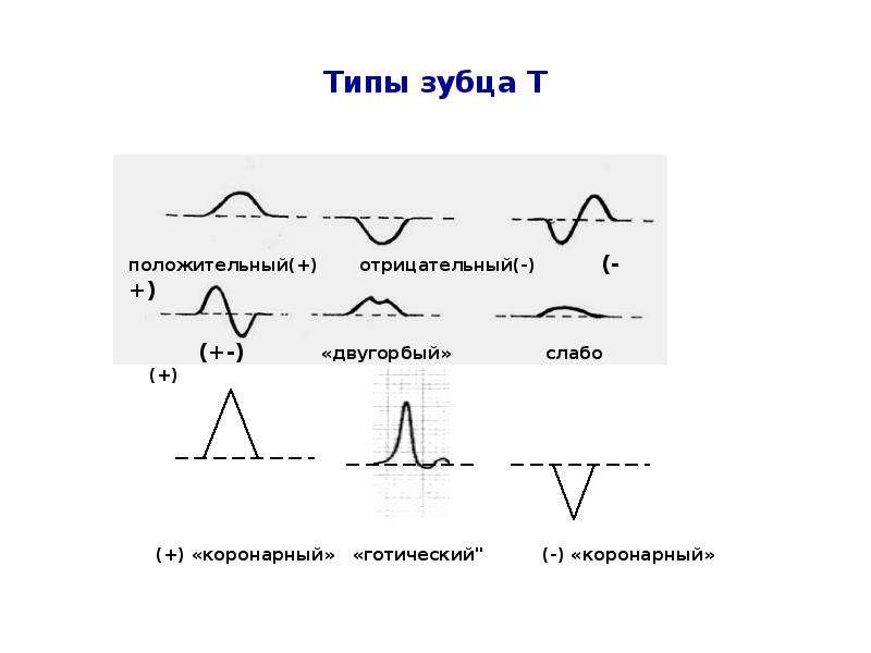 Сглажена т на экг