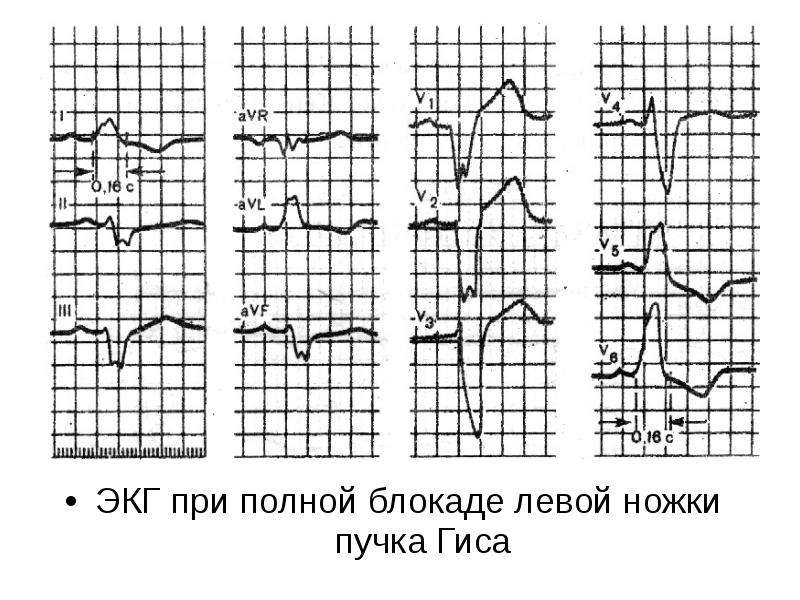 Экг блокада левой ножки пучка гиса фото