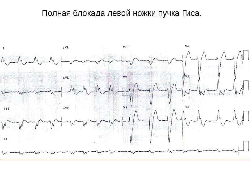 Полная блокада левой