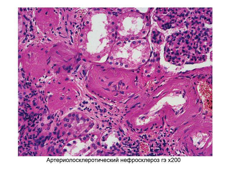 Артериолосклеротический нефросклероз микропрепарат рисунок
