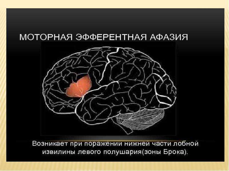 Моторная афазия презентация