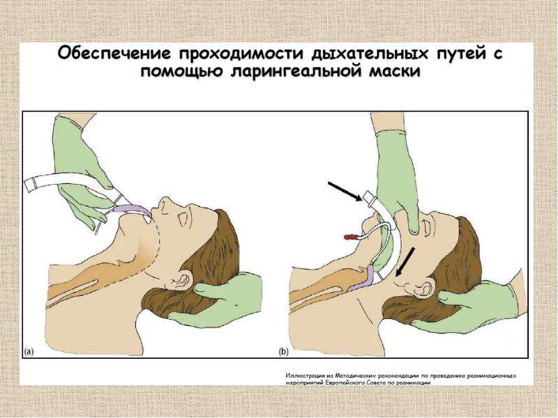 Как обеспечить восстановление дыхательных путей. Обеспечение проходимости дыхательных путей фото. Герметизация с помощью ларингеальной маски. Устройства для обеспечения проходимости дыхательных путей.