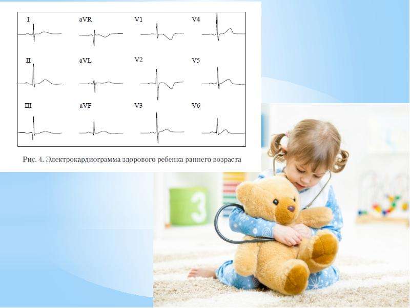 Электрокардиограммы у детей в разные возрастные периоды, слайд 11