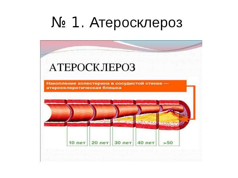 Атеросклероз 1 степени. Атеросклероз картинки для презентации. Схема изменения сосудистой стенки при атеросклерозе чб. Линия кортнона при атеросклерозе. Клиника атеросклероза картинки.