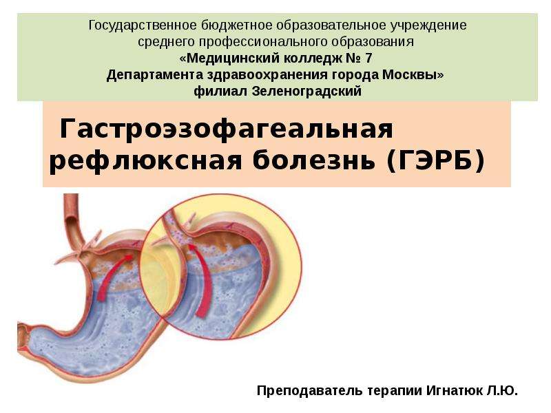 Гастроэзофагеальная болезнь. Гастроэзофагеальная рефлюксная болезнь. Гастроэзофагеальная рефлюксная болезнь презентация. Гастроэзофагеальной рефлюксной. ГЭРБ У детей презентация.