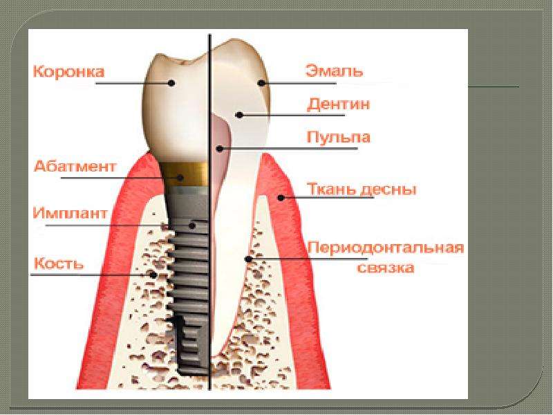 Имплантат в кости