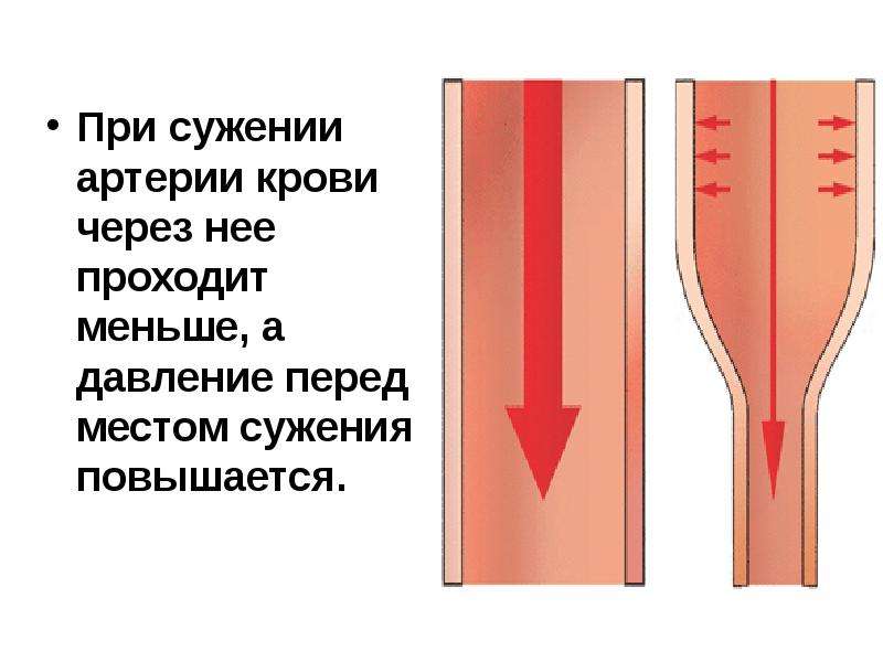 Расширение сужение