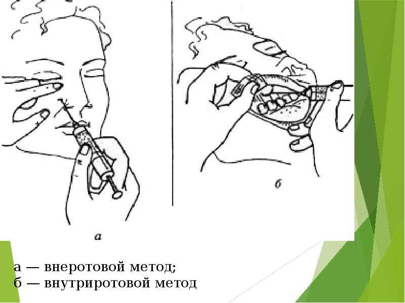 Анестезия на верхней челюсти. Туберальная анестезия, слайд 15