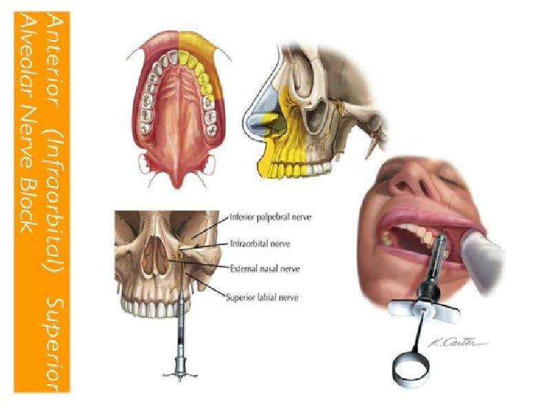 Анестезия на верхней челюсти. Туберальная анестезия, слайд 16