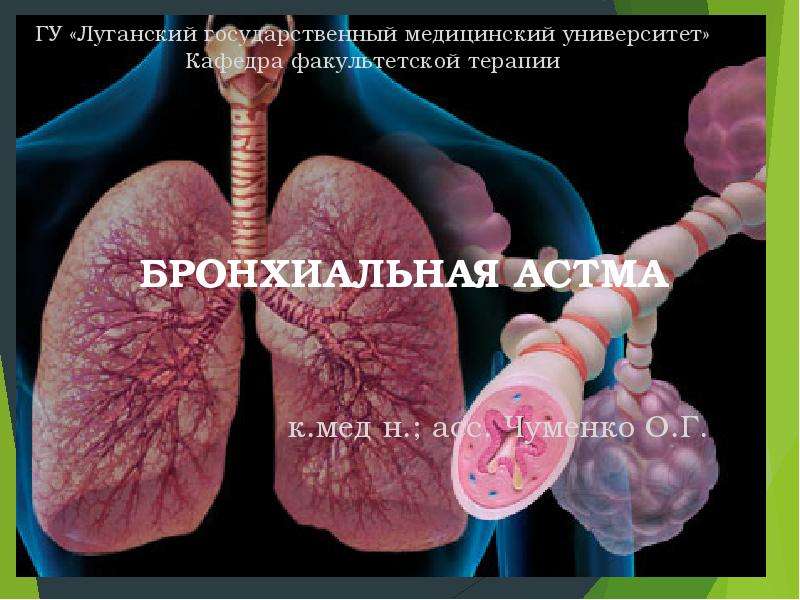 Реферат по теме Терапия (бронхиальная астма)