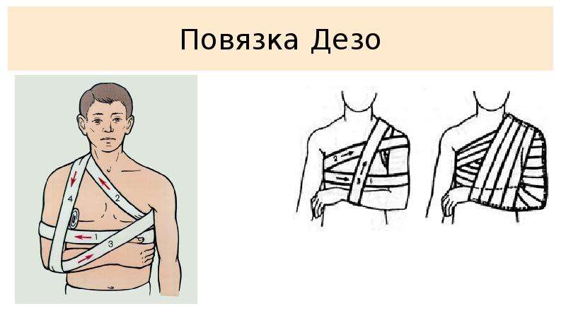 Повязка дезо техника наложения в картинках пошагово