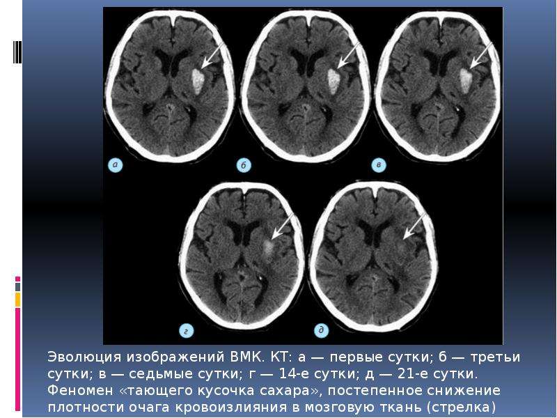 Геморрагический инсульт презентация