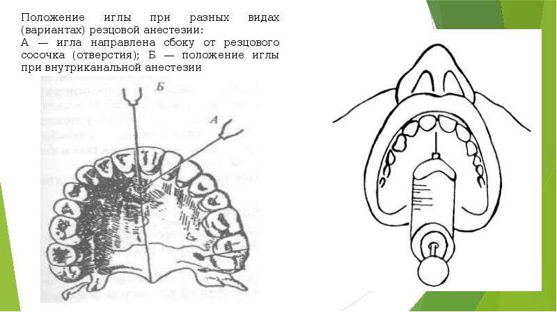 Резцовый