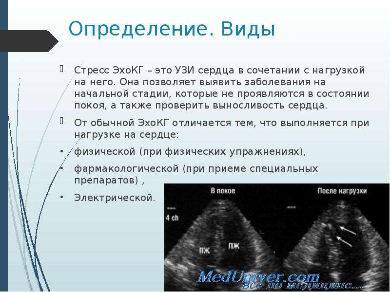 Стресс эхокг презентация